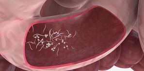 Utilizarea tripletelor pentru a elimina paraziții