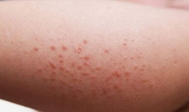 manifestări externe ale prezenței paraziților în organism